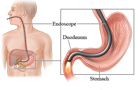 Picture of upper gastrointestinal endoscopy