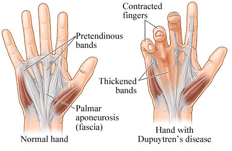 Picture of normal hand and hand with Dupuytren's disease