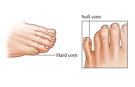 Hard and soft corns on toes.