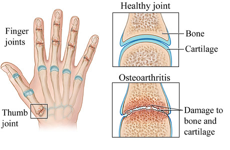 Osteoarthritis of the hand