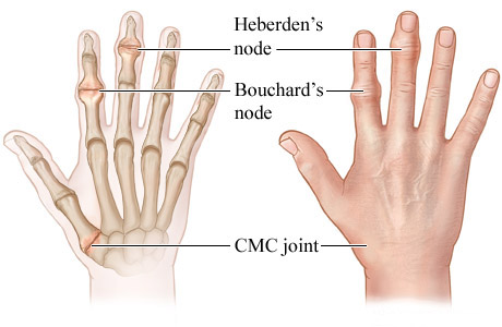 Heberden's and Bouchard's nodes and CMC joint
