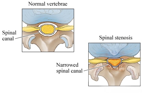 Picture of a normal spinal canal and a narrowed spinal canal (cross section)