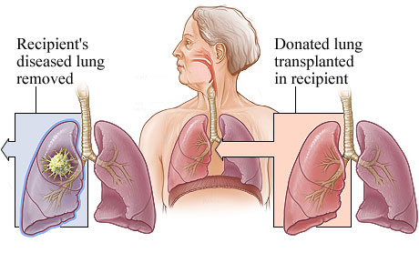 Picture of lung transplant