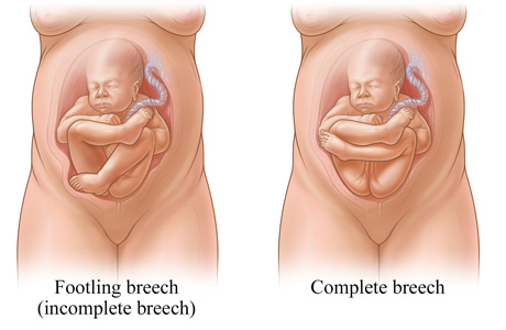 Footling (incomlete) and complete breech positions