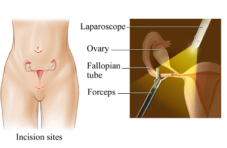 Picture of laparoscopic tubal ligation for female sterilization