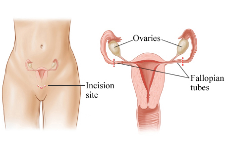 Picture of mini-laparotomy for female sterilization