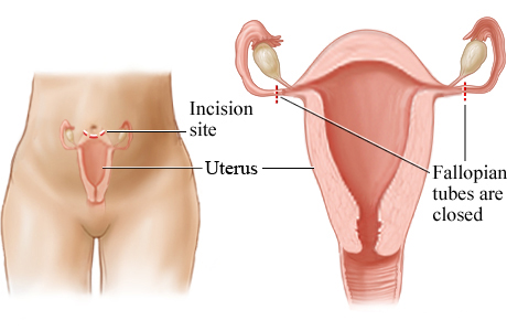 Picture of postpartum tubal ligation