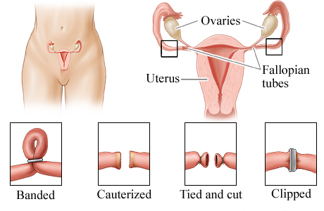 Picture of ligation methods for female sterilization