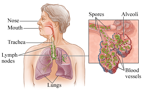 Picture of inhalational anthrax