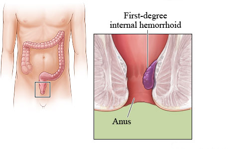 Picture of a first-degree internal hemorrhoid