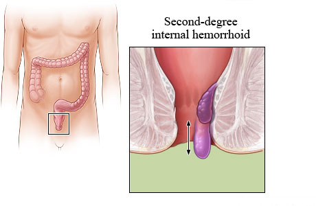 Picture of a second-degree internal hemorrhoid