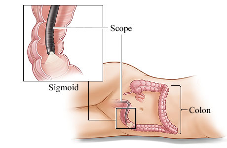 Colonoscope in the colon