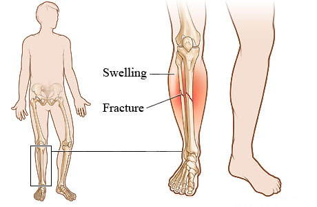 Picture of a lower leg fracture