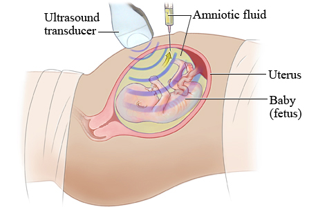 Picture of how an amniocentesis is done