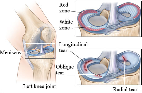 Meniscus healing zones and types of meniscus tears