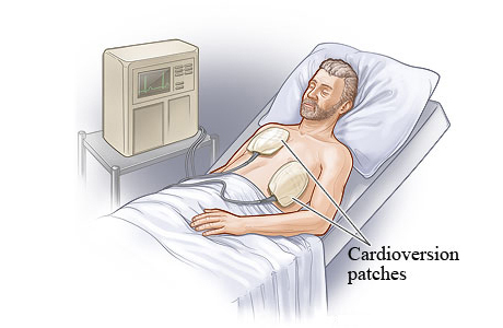 Electrical cardioversion with patches on chest.