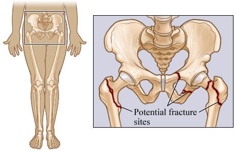 Potential pelvic and hip fracture sites