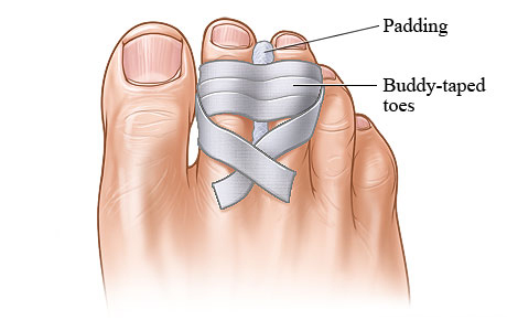 Broken toe buddy-taped to uninjured toe next to it, with padding in between the toes.