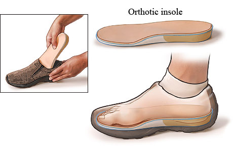 View of foot inside shoe resting on orthotic insole, with detail of insole placement in shoe