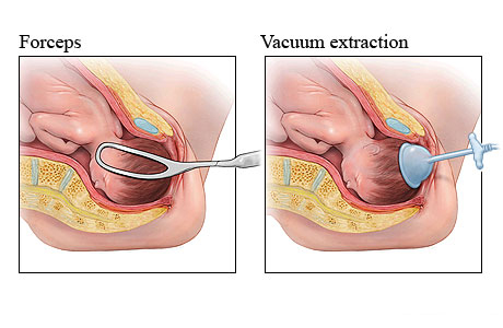 Forceps and vacuum extraction methods for assisted delivery of a baby