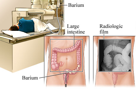 Barium enema and how it looks on an X-ray