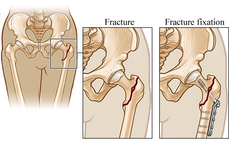 Hip repair for a hip fracture