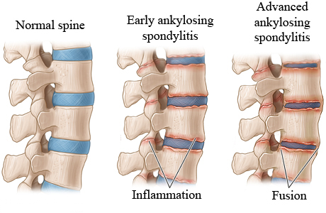 The stages of ankylosing spondylitis in the spine.