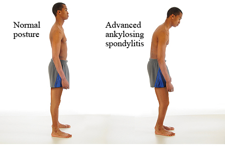 Normal posture compared to the posture of advanced ankylosing spondylitis