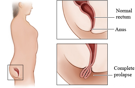Rectal prolapse