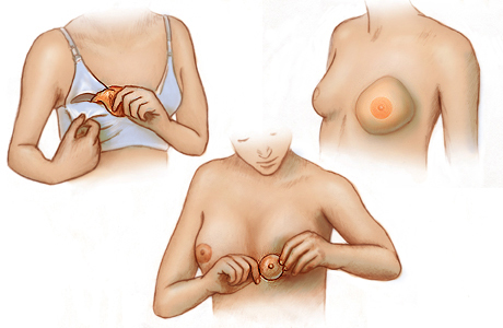 Three types of breast forms