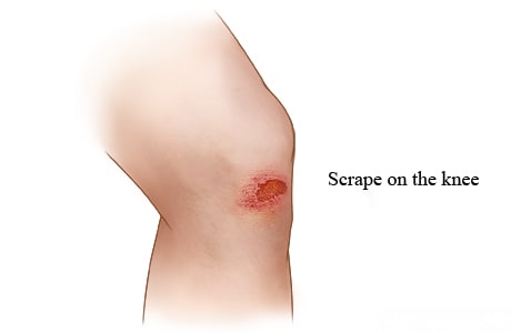 Picture of a scrape on the knee