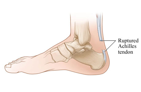 Ruptured Achilles tendon