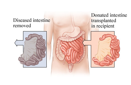 Picture of intestinal transplant