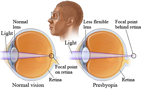 What causes presbyopia (blurred near vision)