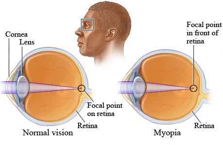 What causes myopia (nearsightedness)