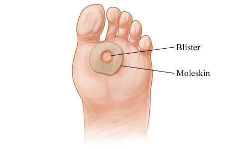 Doughnut-shaped pad surrounding blister on bottom of foot.