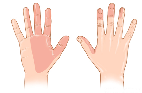 Areas of skin feeling supplied by the median nerve