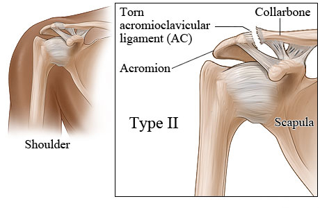 Type II shoulder separation