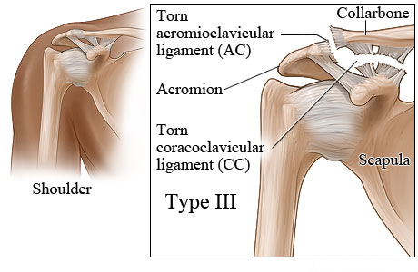 Type III shoulder separation