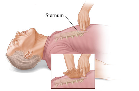 Positioning the hands for chest compressions.