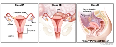 Three-panel drawing of stage IIA, stage IIB, and stage II primary peritoneal cancer; the first panel (stage IIA) shows cancer inside both ovaries that has spread to the fallopian tube and uterus. Also shown are the cervix and vagina. The second panel (stage IIB) shows cancer inside both ovaries that has spread to the colon. The third panel (primary peritoneal cancer) shows cancer in the pelvic peritoneum.