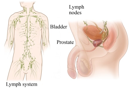 Lymph system throughout male body, with detail showing lymph nodes near bladder and prostate.