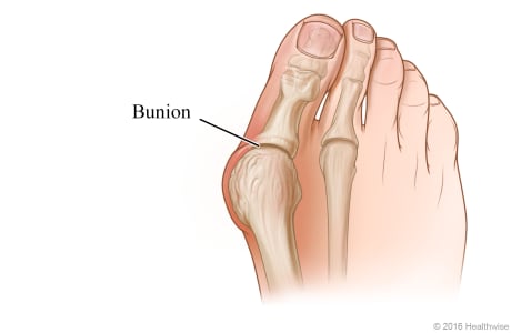 A bunion and the joint at the base of the big toe.