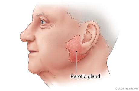 Side view of person's face, showing parotid gland in front of and slightly below ear.
