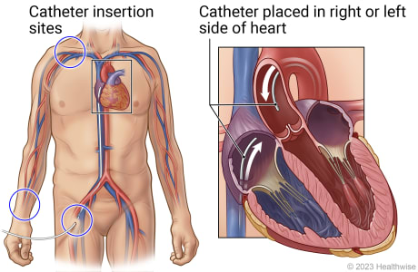 Catheter insertion points at neck, wrist, and groin, showing catheter placed in right side of heart or in left side.