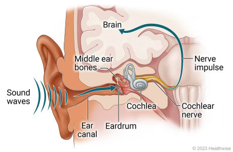 Sound waves enter ear through ear canal to eardrum, to middle ear bones, and on to inner ear, and nerve impulse travels through cochlear nerve to brain.