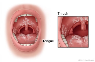 Thrush in mouth, with close-up of thrush on tongue and roof of mouth.
