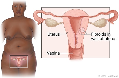 Female reproductive organs in pelvis, including uterus and vagina, with detail showing fibroids growing in wall of uterus.