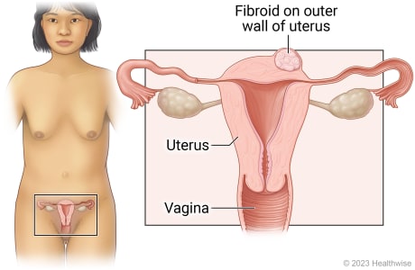 Female reproductive organs in pelvis, including uterus and vagina, with detail showing fibroid on outer wall of uterus.