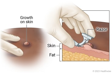 Growth on skin, with cross-section of layers of skin and fat, and growth being removed from surface of skin with razor.